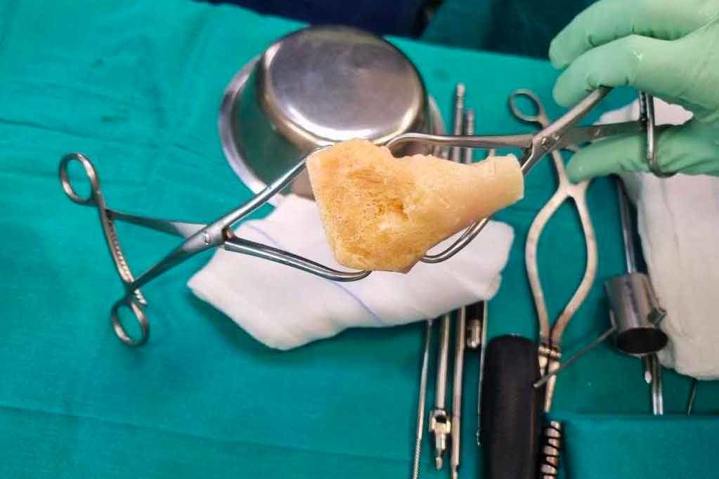 Primera cirugía con injerto de hueso en el Molina Orosa