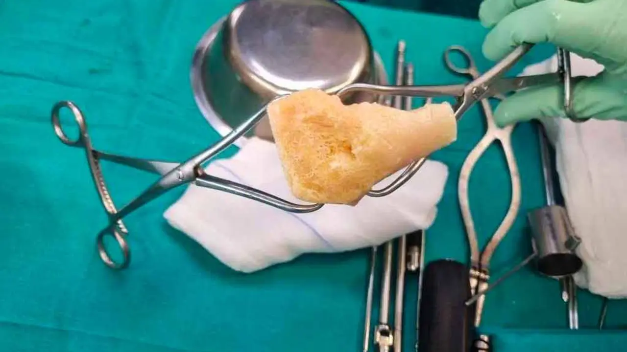 Primera cirug&iacute;a con injerto de hueso en el Molina Orosa